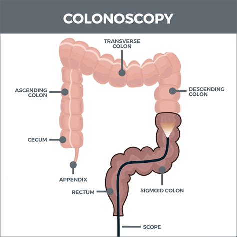This very rare complication can cause severe abdominal pain, rapid heart rate, and fever after a colonoscopy. . Can a colonoscopy make a rectocele worse